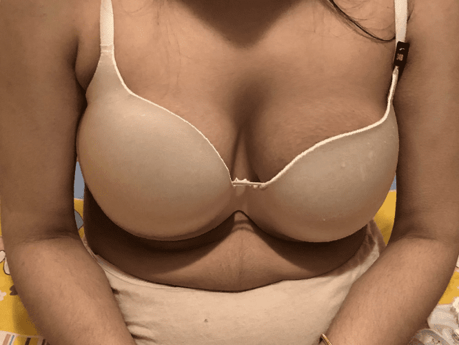 Screenshot_2018-12-17 https www breastimplantsbymentor com(38).png